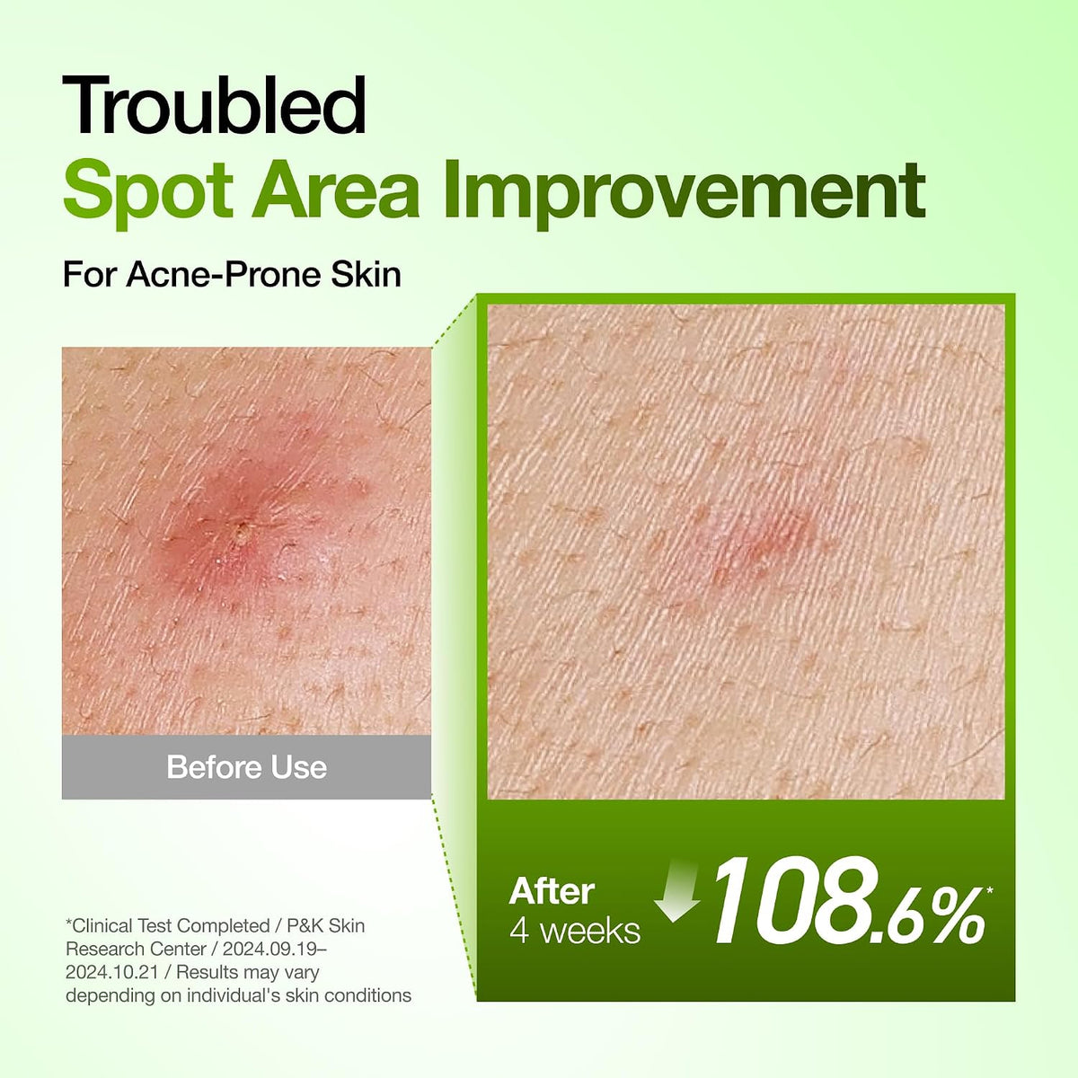 ANUA Azelaic Acid 10 Hyaluron Redness Soothing Serum 30ml | ANUA Azelaic Acid 10% হায়ালুরন রেডনেস সুথিং সিরাম