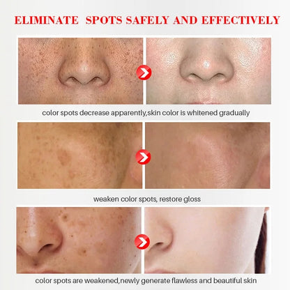 Whitening Freckle Cream Remove Dark Spots Remove Melasma Anti Freckle Cream Fade Pigmentation Anti-Aging Light Skin Care