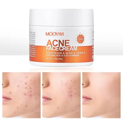 Mooyam Tea Tree Oil Face Cream 50g | Mooyam টি ট্রি অয়েল অ্যাকনে কেয়ার ফেস ক্রিম