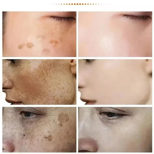 Whiten Cream Brighten Face Effective Remove Melasma Dark Spot Improve Dullness Skin Anti-pigmentation Care Cream Care Products