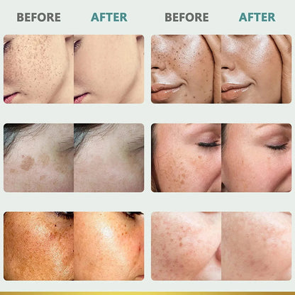 Whiten Cream Brighten Face Effective Remove Melasma Dark Spot Improve Dullness Skin Anti-pigmentation Care Cream Care Products