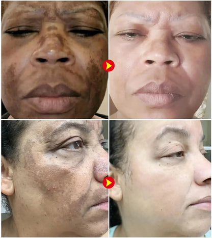 Whiten Cream Brighten Face Effective Remove Melasma Dark Spot Improve Dullness Skin Anti-pigmentation Care Cream Care Products